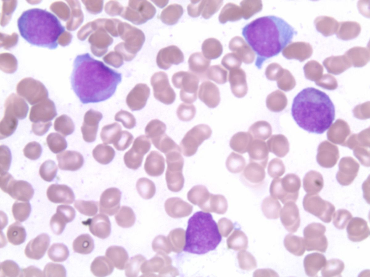 Day 22 bone marrow aspirate